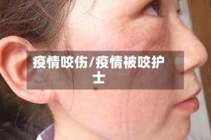 疫情咬伤/疫情被咬护士
