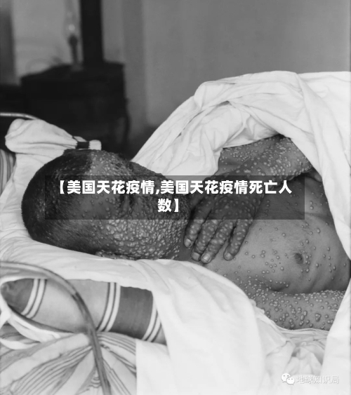 【美国天花疫情,美国天花疫情死亡人数】-第1张图片