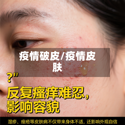 疫情破皮/疫情皮肤-第1张图片